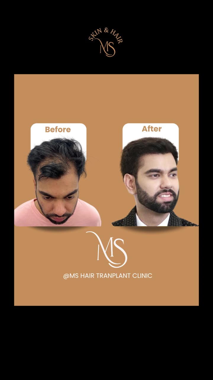 Hair transplant before and after reel video